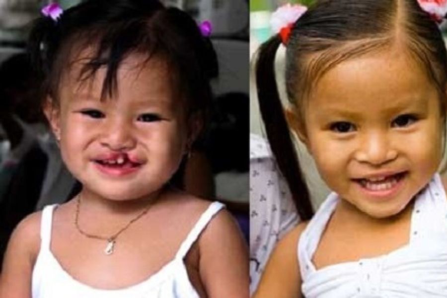 Sbobetsilo.com ủng hộ 1 tỷ đồng vào quỹ Phẩu thuật nụ cười cho trẻ em hở hàm ếch